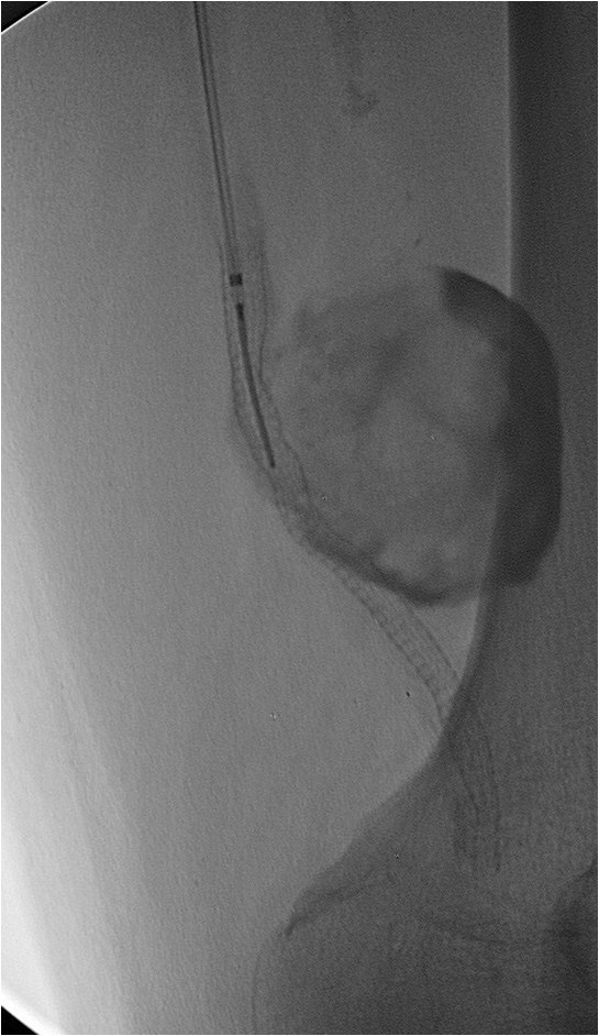 Rotura y posterior trombosis de “bypass” femoropoplíteo, con oclusión crónica de troncos distales: solución endovascular — diapositiva 33