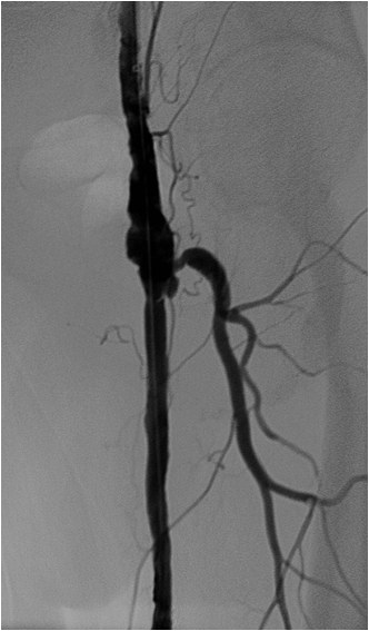 Rotura y posterior trombosis de “bypass” femoropoplíteo, con oclusión crónica de troncos distales: solución endovascular — diapositiva 34