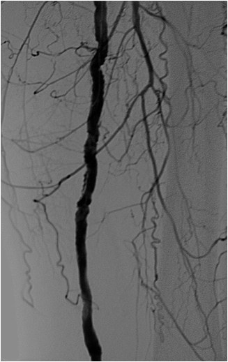 Rotura y posterior trombosis de “bypass” femoropoplíteo, con oclusión crónica de troncos distales: solución endovascular — diapositiva 35