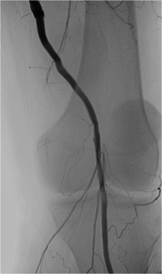 Rotura y posterior trombosis de “bypass” femoropoplíteo, con oclusión crónica de troncos distales: solución endovascular — diapositiva 36