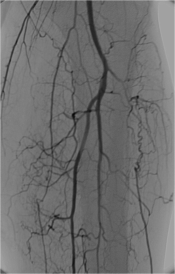 Rotura y posterior trombosis de “bypass” femoropoplíteo, con oclusión crónica de troncos distales: solución endovascular — diapositiva 37