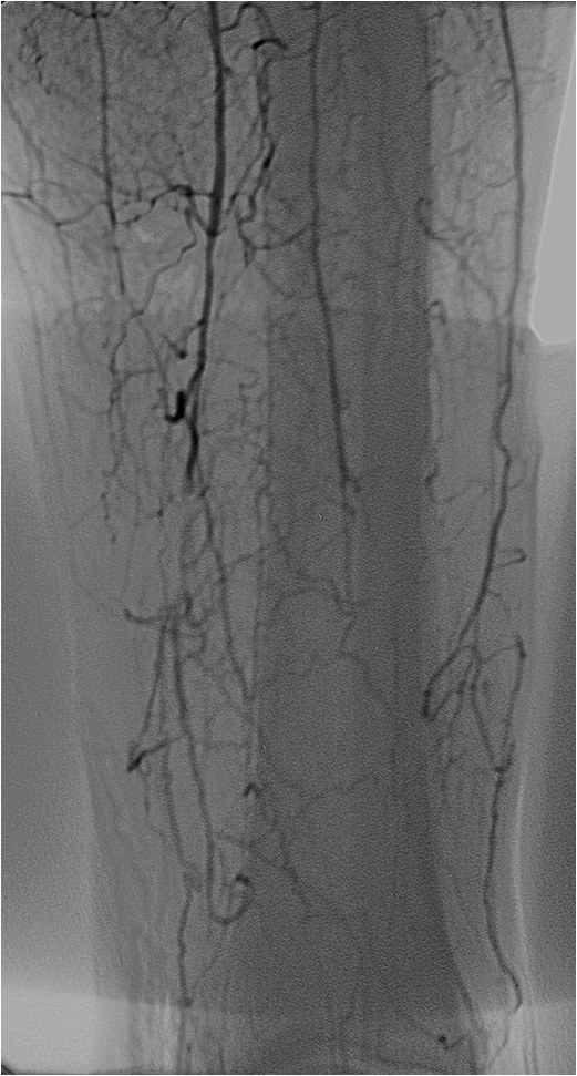 Rotura y posterior trombosis de “bypass” femoropoplíteo, con oclusión crónica de troncos distales: solución endovascular — diapositiva 38