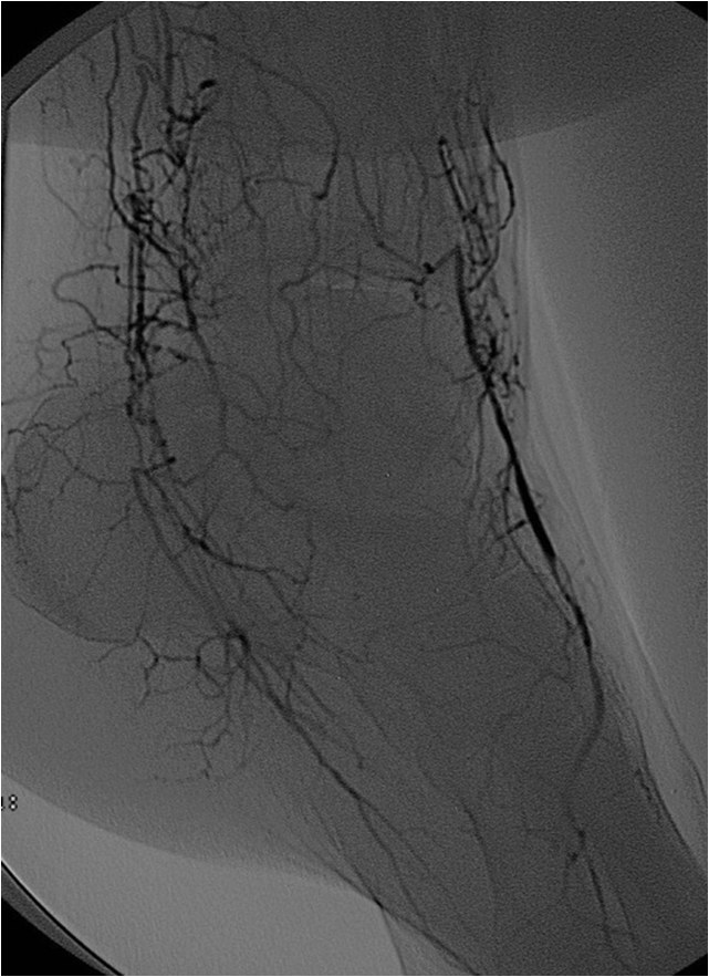 Rotura y posterior trombosis de “bypass” femoropoplíteo, con oclusión crónica de troncos distales: solución endovascular — diapositiva 39