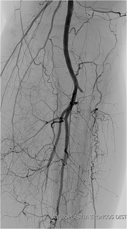 Rotura y posterior trombosis de “bypass” femoropoplíteo, con oclusión crónica de troncos distales: solución endovascular — diapositiva 40