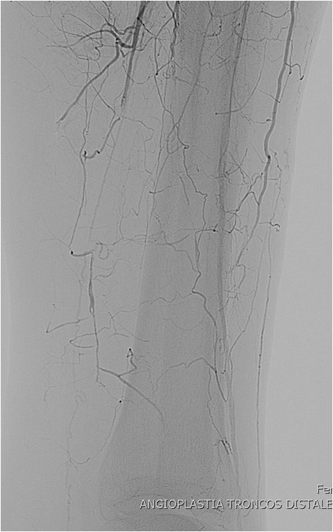 Rotura y posterior trombosis de “bypass” femoropoplíteo, con oclusión crónica de troncos distales: solución endovascular — diapositiva 41