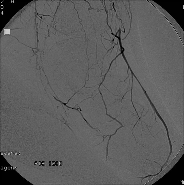 Rotura y posterior trombosis de “bypass” femoropoplíteo, con oclusión crónica de troncos distales: solución endovascular — diapositiva 42