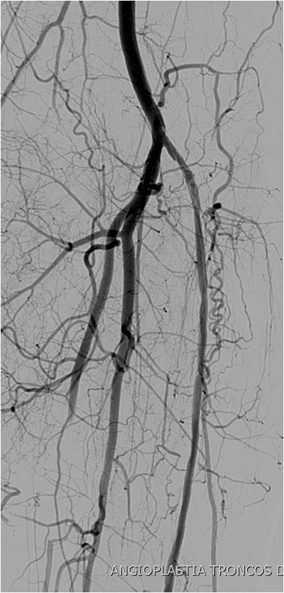 Rotura y posterior trombosis de “bypass” femoropoplíteo, con oclusión crónica de troncos distales: solución endovascular — diapositiva 43