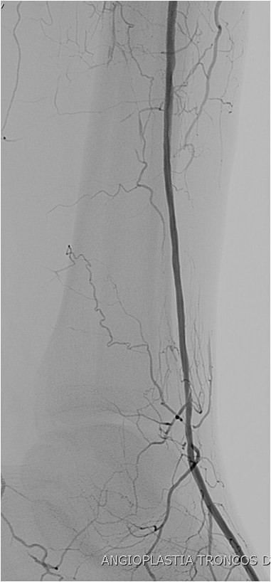 Rotura y posterior trombosis de “bypass” femoropoplíteo, con oclusión crónica de troncos distales: solución endovascular — diapositiva 44