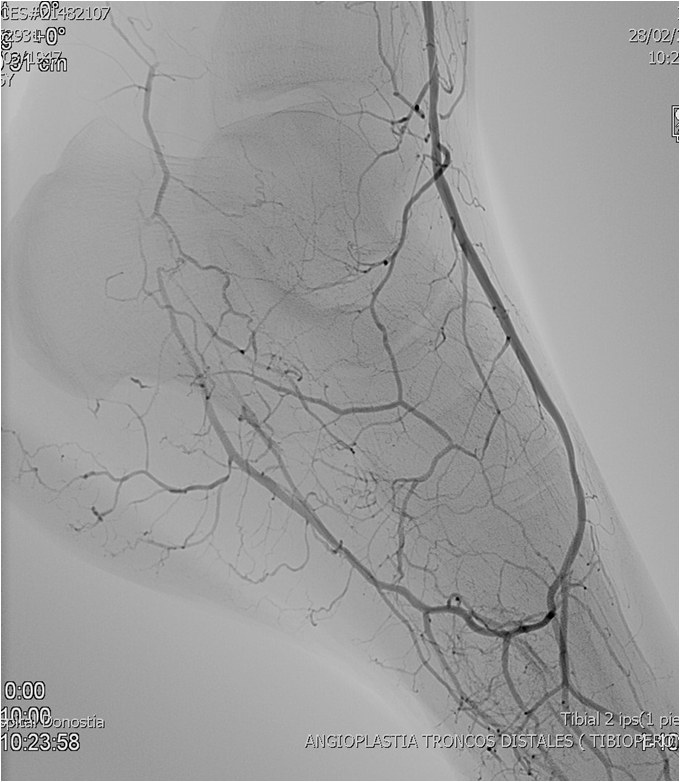 Rotura y posterior trombosis de “bypass” femoropoplíteo, con oclusión crónica de troncos distales: solución endovascular — diapositiva 45