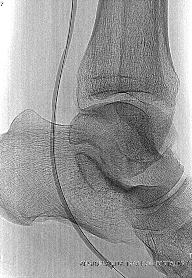 Rotura y posterior trombosis de “bypass” femoropoplíteo, con oclusión crónica de troncos distales: solución endovascular — diapositiva 46