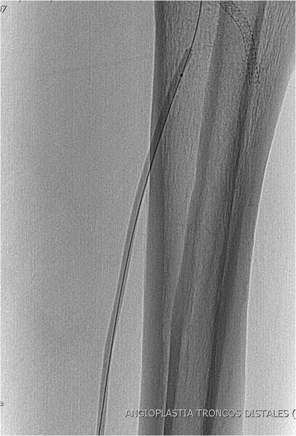 Rotura y posterior trombosis de “bypass” femoropoplíteo, con oclusión crónica de troncos distales: solución endovascular — diapositiva 47