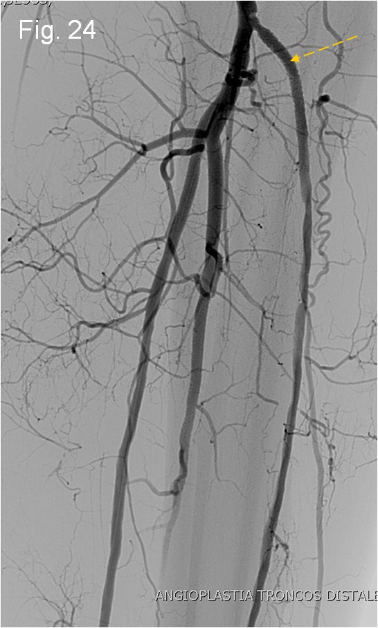 Rotura y posterior trombosis de “bypass” femoropoplíteo, con oclusión crónica de troncos distales: solución endovascular — diapositiva 48