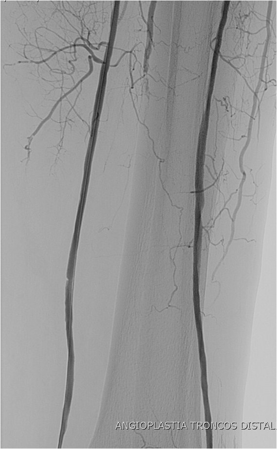 Rotura y posterior trombosis de “bypass” femoropoplíteo, con oclusión crónica de troncos distales: solución endovascular — diapositiva 49