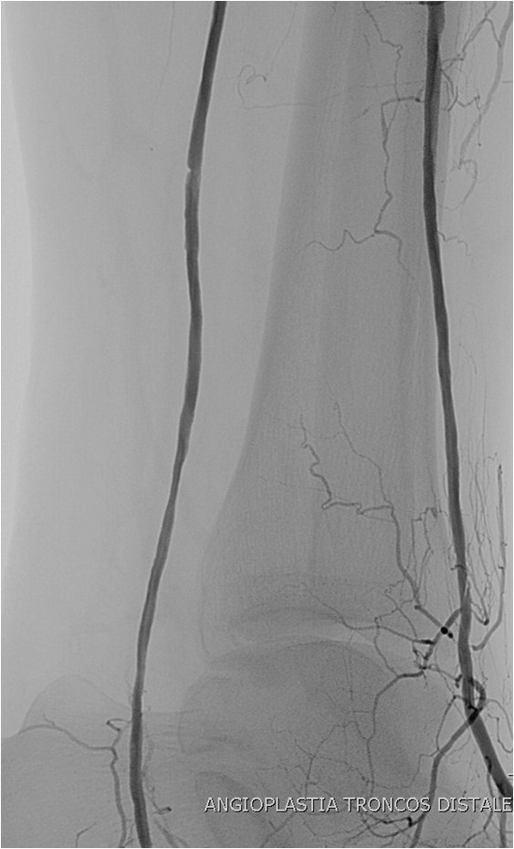 Rotura y posterior trombosis de “bypass” femoropoplíteo, con oclusión crónica de troncos distales: solución endovascular — diapositiva 50