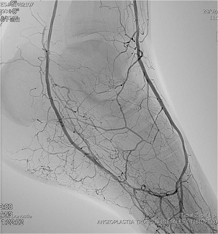 Rotura y posterior trombosis de “bypass” femoropoplíteo, con oclusión crónica de troncos distales: solución endovascular — diapositiva 51