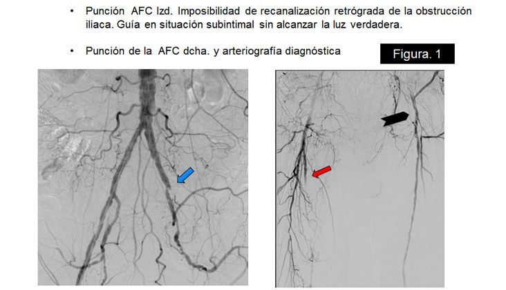 Rotura yatrógena de arteria Iliaca – Tratamiento con Stent recubierto — diapositiva 5