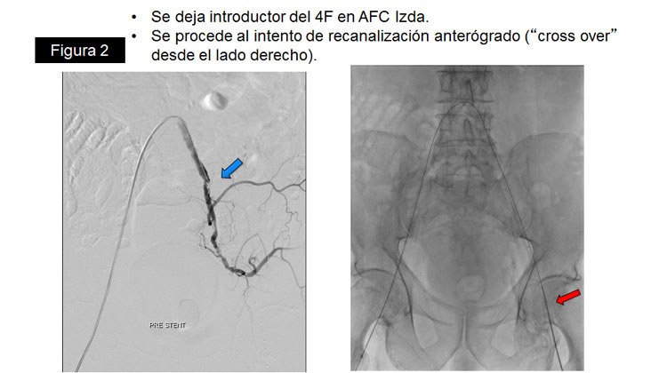 Rotura yatrógena de arteria Iliaca – Tratamiento con Stent recubierto — diapositiva 6