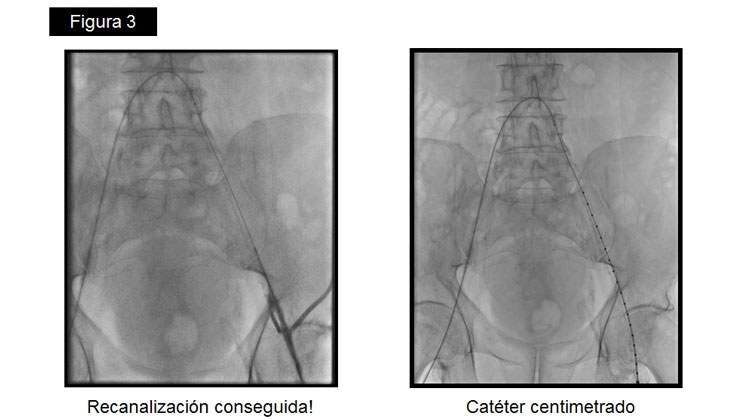 Rotura yatrógena de arteria Iliaca – Tratamiento con Stent recubierto — diapositiva 7