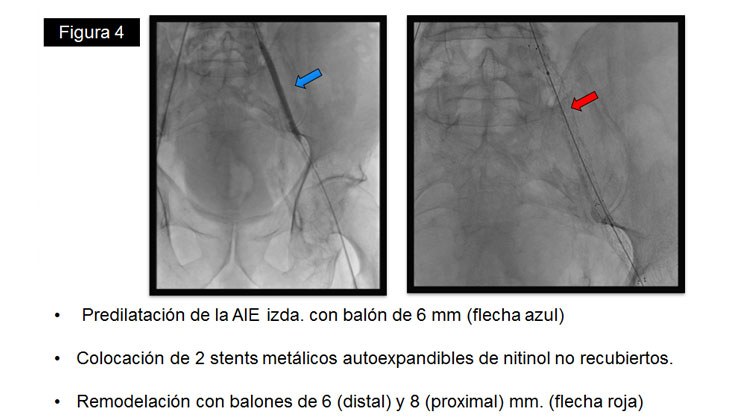 Rotura yatrógena de arteria Iliaca – Tratamiento con Stent recubierto — diapositiva 8