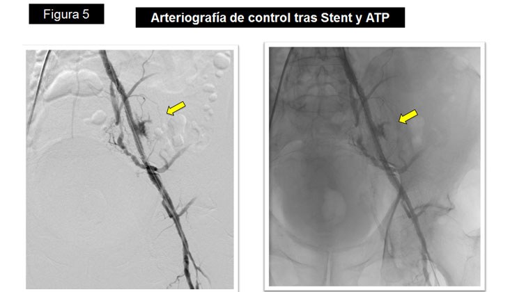 Rotura yatrógena de arteria Iliaca – Tratamiento con Stent recubierto — diapositiva 9