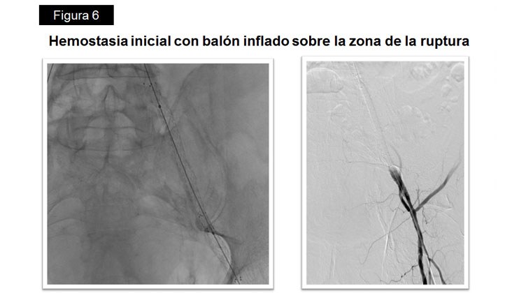 Rotura yatrógena de arteria Iliaca – Tratamiento con Stent recubierto — diapositiva 10
