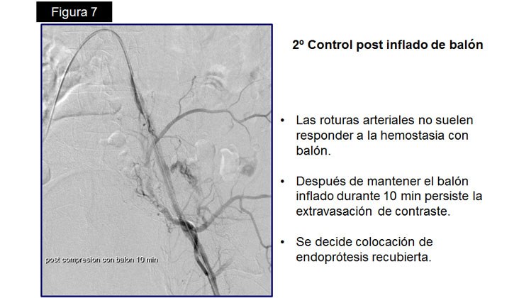 Rotura yatrógena de arteria Iliaca – Tratamiento con Stent recubierto — diapositiva 11
