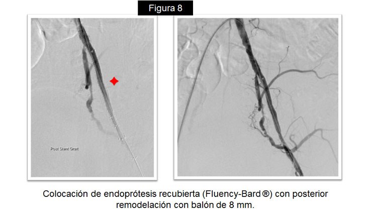 Rotura yatrógena de arteria Iliaca – Tratamiento con Stent recubierto — diapositiva 12