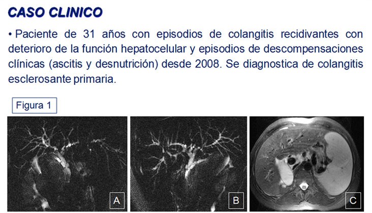 Síndrome de robo de la arteria esplénica en el trasplante hepático — diapositiva 2