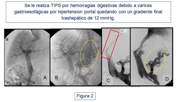 Síndrome de robo de la arteria esplénica en el trasplante hepático — diapositiva 3