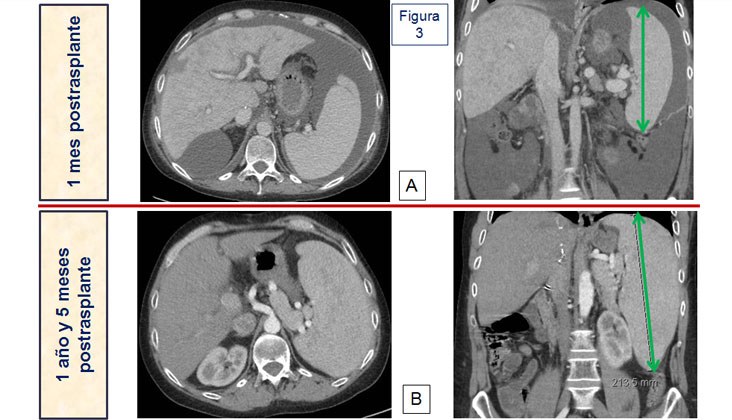 Síndrome de robo de la arteria esplénica en el trasplante hepático — diapositiva 5