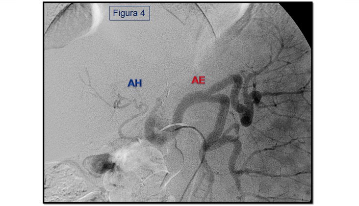 Síndrome de robo de la arteria esplénica en el trasplante hepático — diapositiva 7