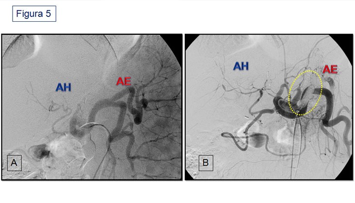 Síndrome de robo de la arteria esplénica en el trasplante hepático — diapositiva 8