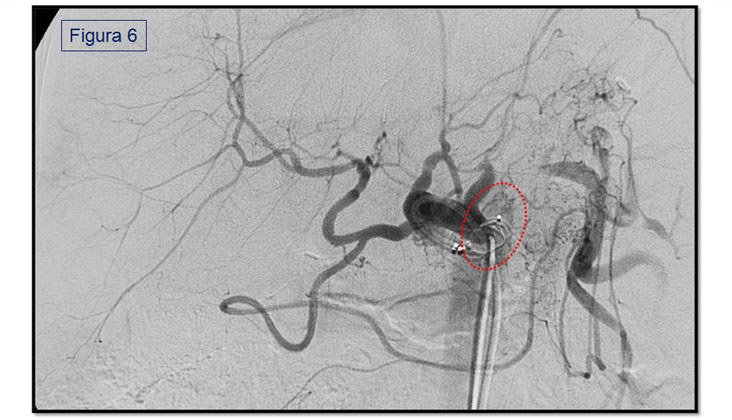 Síndrome de robo de la arteria esplénica en el trasplante hepático — diapositiva 9