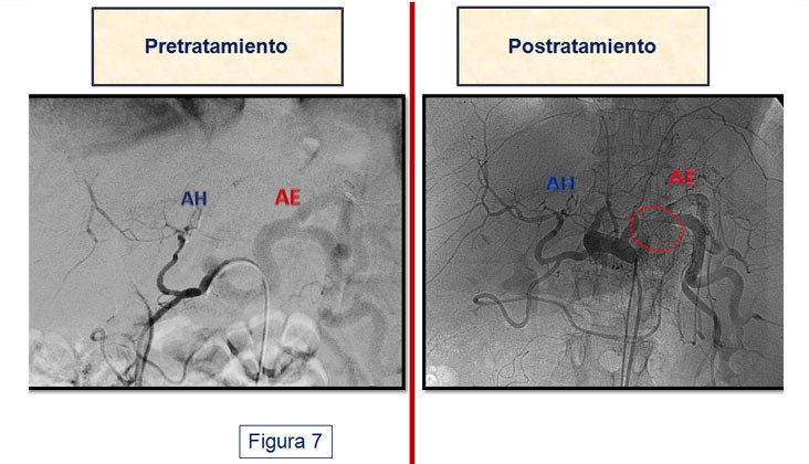 Síndrome de robo de la arteria esplénica en el trasplante hepático — diapositiva 10