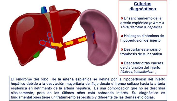 Síndrome de robo de la arteria esplénica en el trasplante hepático — diapositiva 11