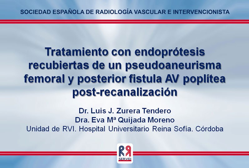 Tratamiento con endoprótesis recubiertas de un pseudoaneurisma femoral y posterior fistula AV poplítea post-recanalización — diapositiva 1