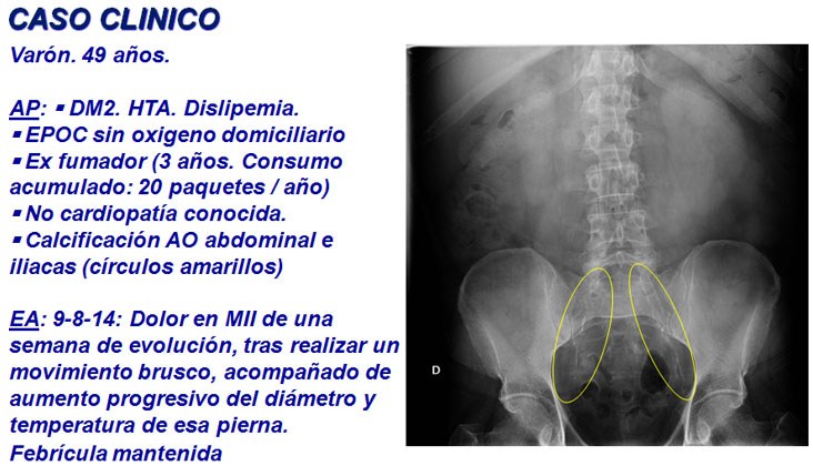 Tratamiento con endoprótesis recubiertas de un pseudoaneurisma femoral y posterior fistula AV poplítea post-recanalización — diapositiva 2