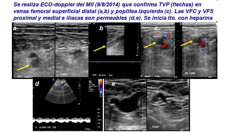 Tratamiento con endoprótesis recubiertas de un pseudoaneurisma femoral y posterior fistula AV poplítea post-recanalización — diapositiva 3