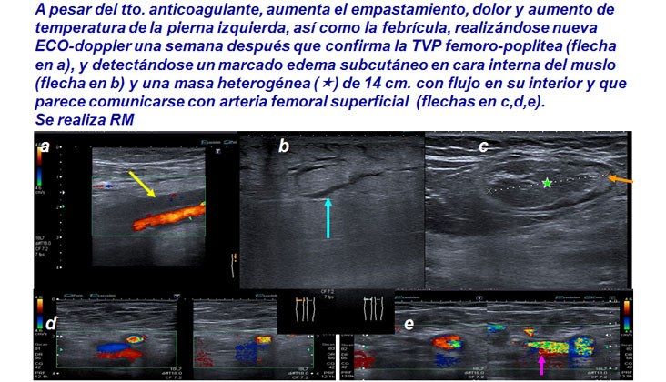 Tratamiento con endoprótesis recubiertas de un pseudoaneurisma femoral y posterior fistula AV poplítea post-recanalización — diapositiva 4