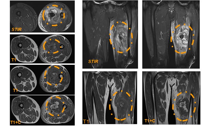 Tratamiento con endoprótesis recubiertas de un pseudoaneurisma femoral y posterior fistula AV poplítea post-recanalización — diapositiva 5