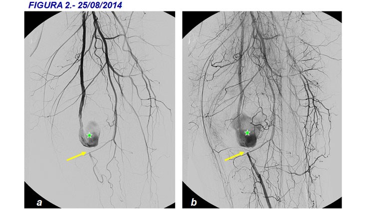 Tratamiento con endoprótesis recubiertas de un pseudoaneurisma femoral y posterior fistula AV poplítea post-recanalización — diapositiva 6