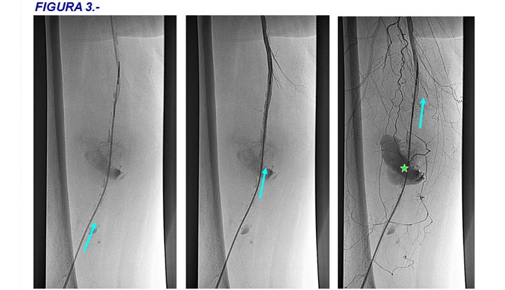 Tratamiento con endoprótesis recubiertas de un pseudoaneurisma femoral y posterior fistula AV poplítea post-recanalización — diapositiva 7
