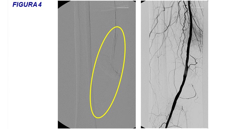Tratamiento con endoprótesis recubiertas de un pseudoaneurisma femoral y posterior fistula AV poplítea post-recanalización — diapositiva 8