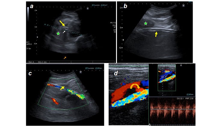 Tratamiento con endoprótesis recubiertas de un pseudoaneurisma femoral y posterior fistula AV poplítea post-recanalización — diapositiva 9