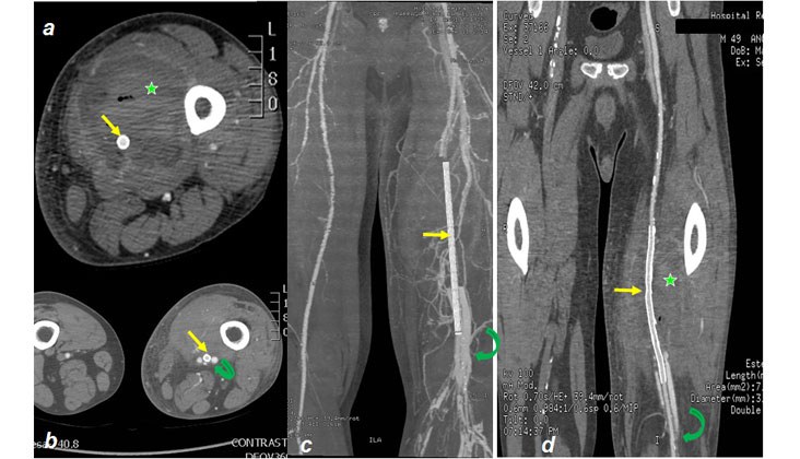 Tratamiento con endoprótesis recubiertas de un pseudoaneurisma femoral y posterior fistula AV poplítea post-recanalización — diapositiva 10