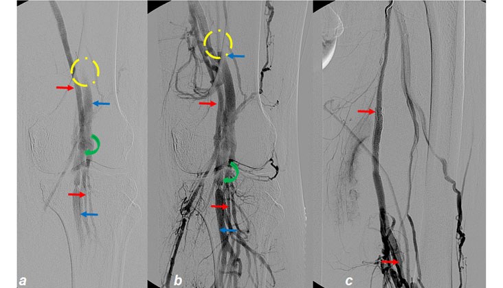 Tratamiento con endoprótesis recubiertas de un pseudoaneurisma femoral y posterior fistula AV poplítea post-recanalización — diapositiva 11
