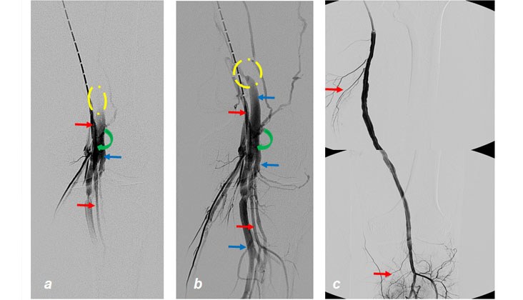 Tratamiento con endoprótesis recubiertas de un pseudoaneurisma femoral y posterior fistula AV poplítea post-recanalización — diapositiva 12