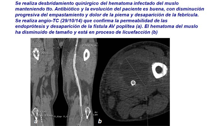 Tratamiento con endoprótesis recubiertas de un pseudoaneurisma femoral y posterior fistula AV poplítea post-recanalización — diapositiva 13