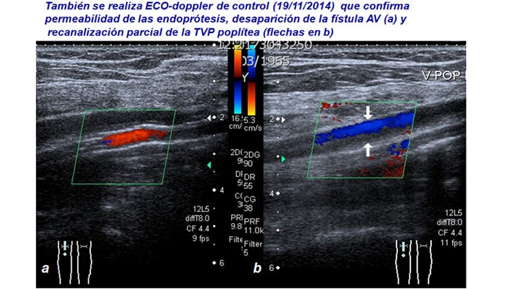 Tratamiento con endoprótesis recubiertas de un pseudoaneurisma femoral y posterior fistula AV poplítea post-recanalización — diapositiva 14