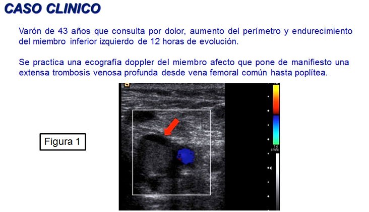 Tratamiento endovascular en el síndrome de may-thurner mediante recanalización y nuevas endoprótesis venosas — diapositiva 2